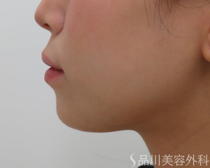 症例NO.65630のBEFORE写真