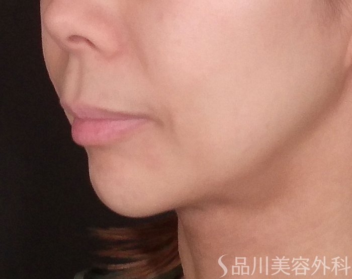 症例NO.69783のBEFORE写真
