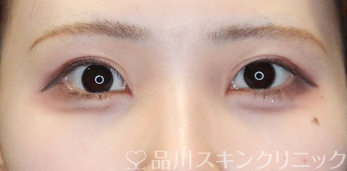 症例NO.65100のBEFORE写真