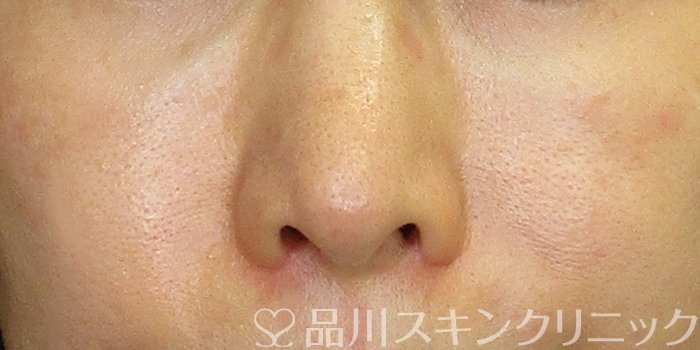 症例NO.74282のAFTER写真