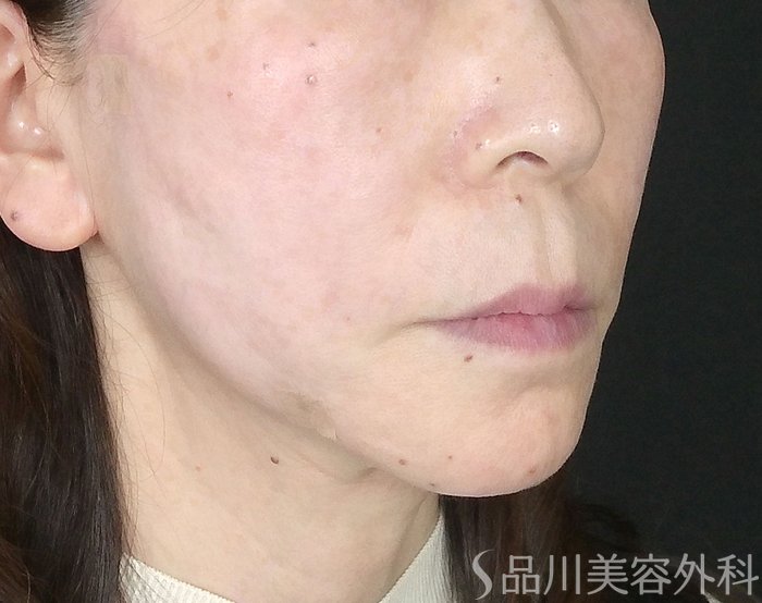 症例NO.69699のAFTER写真