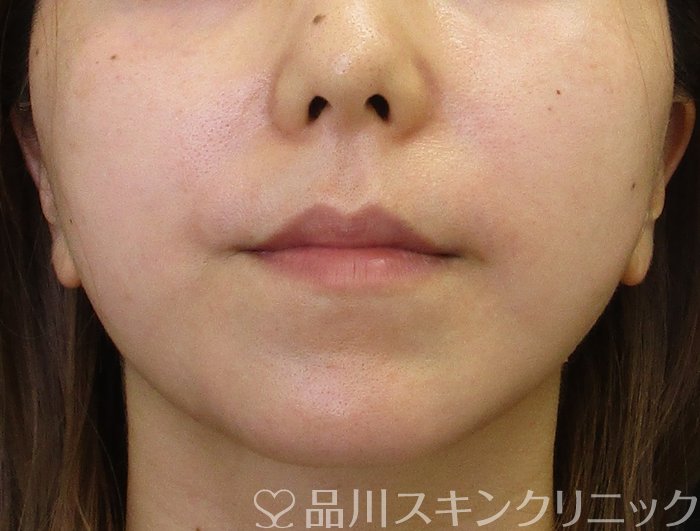 症例NO.65464のAFTER写真