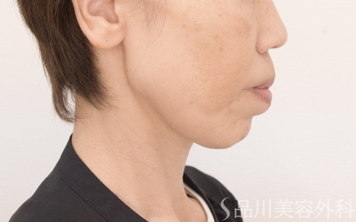 症例NO.71437のBEFORE写真