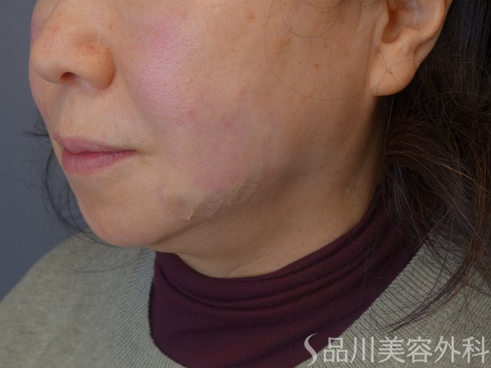 症例NO.72547のAFTER写真