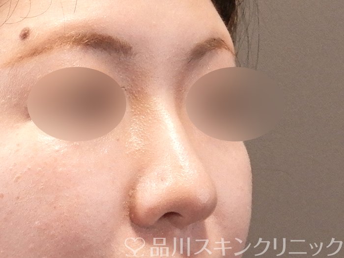症例NO.64613のAFTER写真