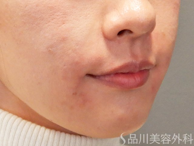 症例NO.69626のAFTER写真