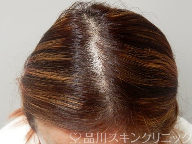 症例NO.69020のAFTER写真