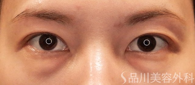 症例NO.72268のBEFORE写真