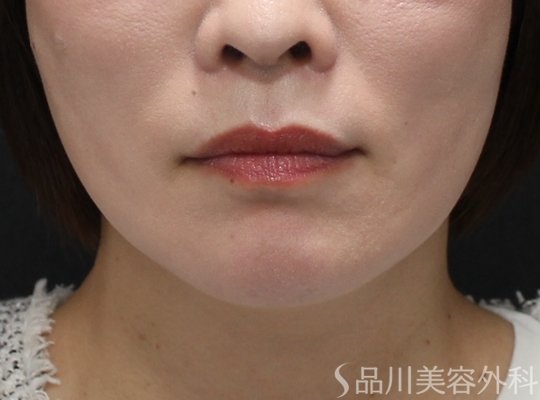 症例NO.75257のAFTER写真