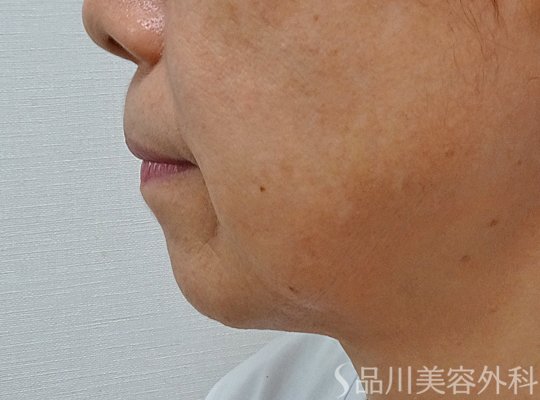 症例NO.73520のBEFORE写真