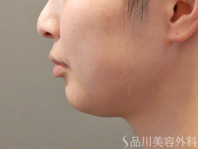 症例NO.74138のBEFORE写真