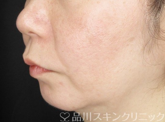 症例NO.64596のBEFORE写真