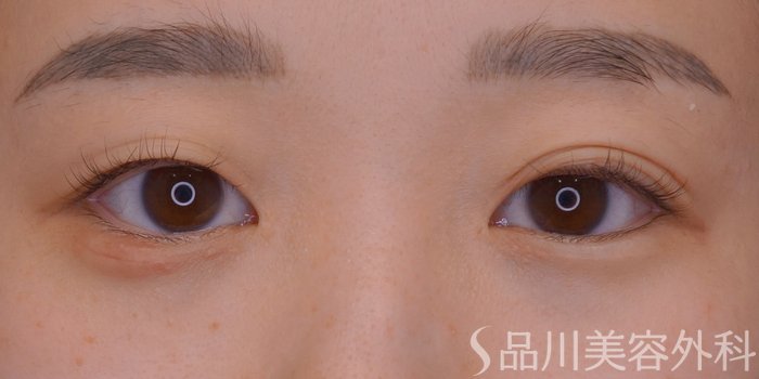 症例NO.73792のBEFORE写真