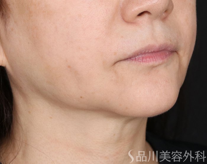 症例NO.71082のBEFORE写真