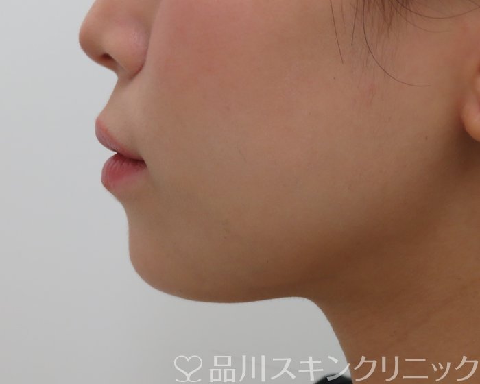 症例NO.65630のBEFORE写真