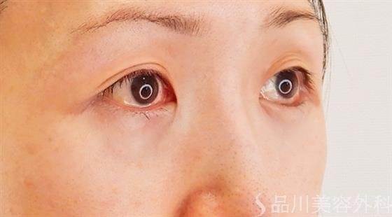 症例NO.60739のAFTER写真