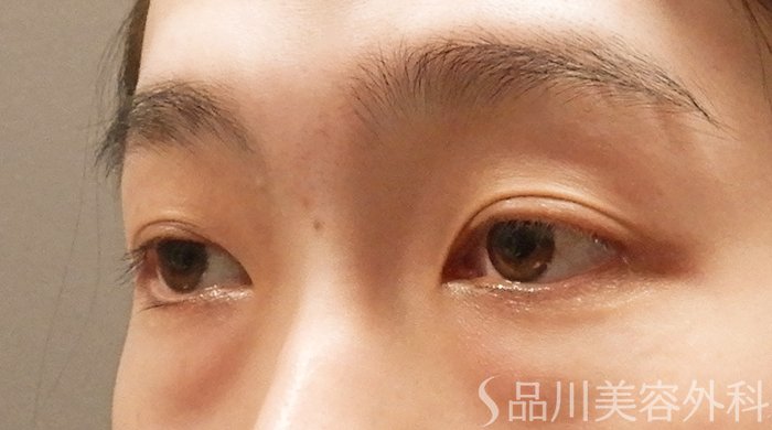 症例NO.69304のBEFORE写真