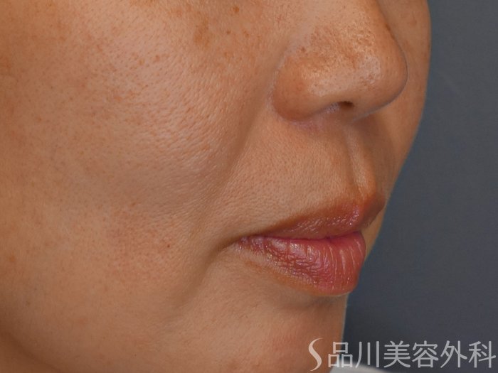 症例NO.71828のBEFORE写真