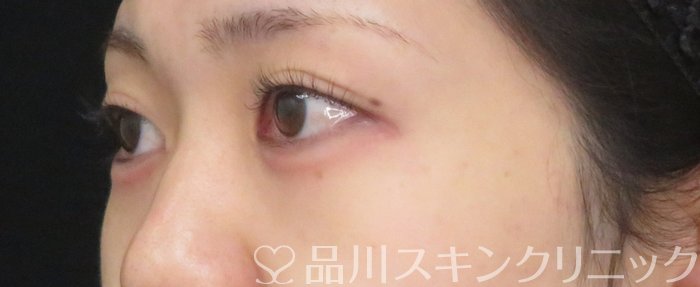 症例NO.74939のAFTER写真