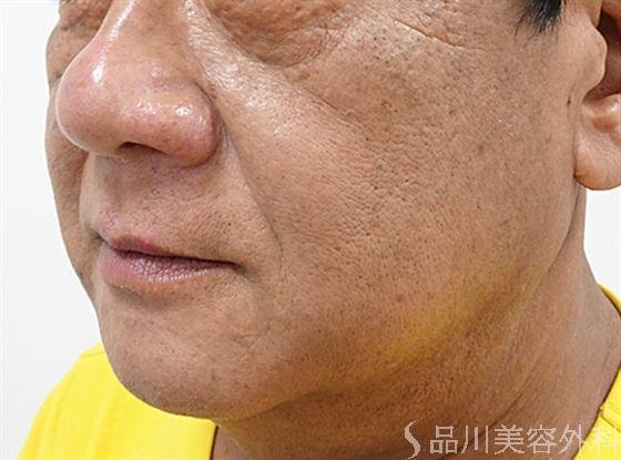 症例NO.55577のBEFORE写真