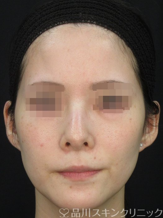 症例NO.72364のBEFORE写真