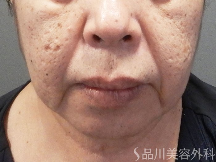 症例NO.71431のBEFORE写真