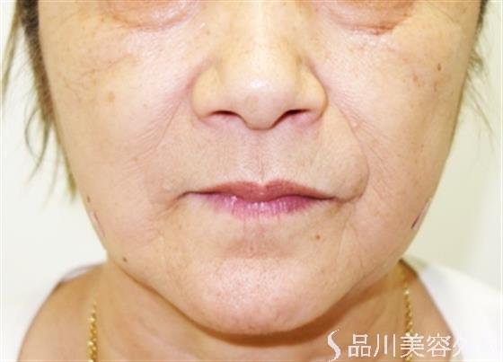 症例NO.48185のAFTER写真