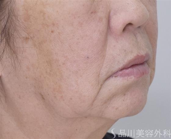 症例NO.49567のBEFORE写真