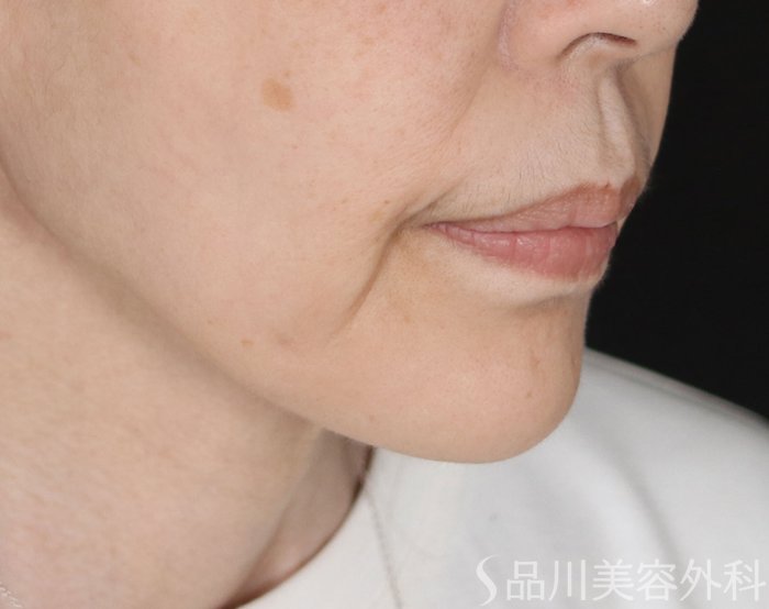 症例NO.73449のBEFORE写真