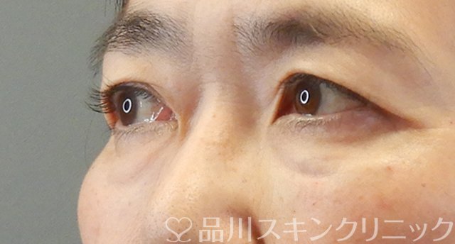 症例NO.67336のAFTER写真