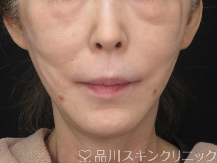 症例NO.69981のAFTER写真