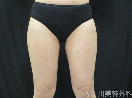 症例NO.46476のBEFORE写真