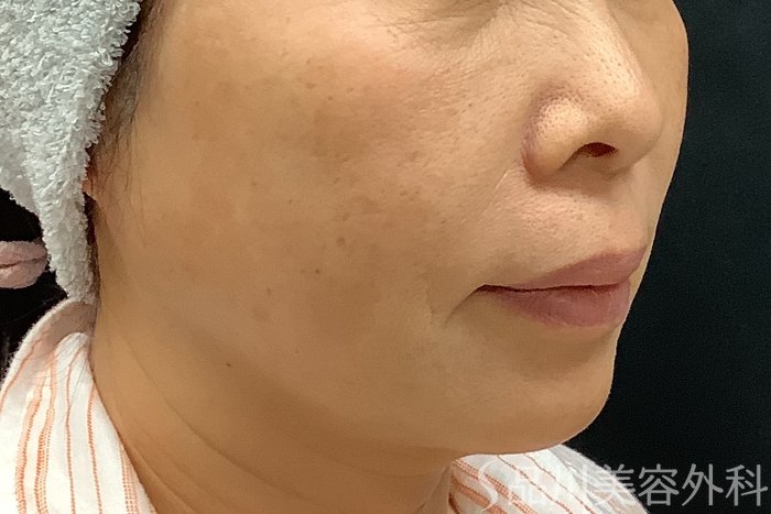 症例NO.66062のBEFORE写真