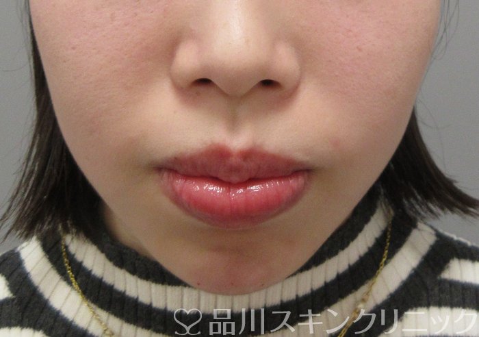 症例NO.69808のAFTER写真