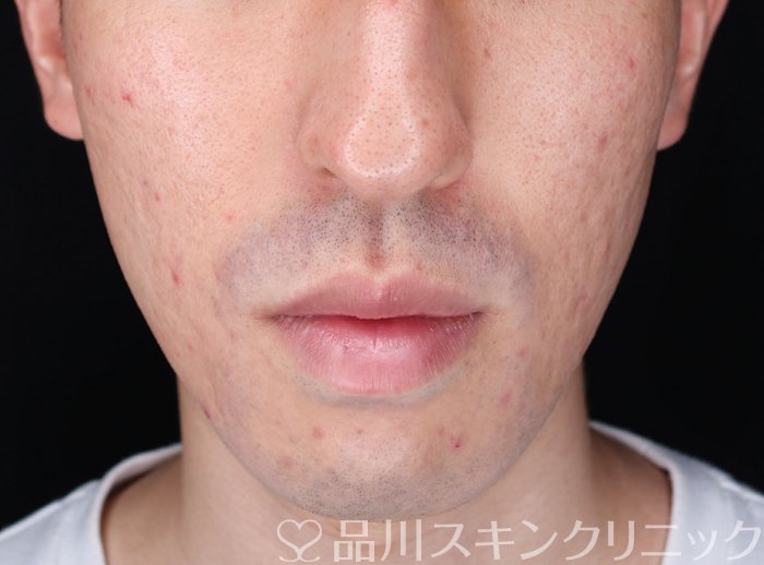 症例NO.72557のBEFORE写真