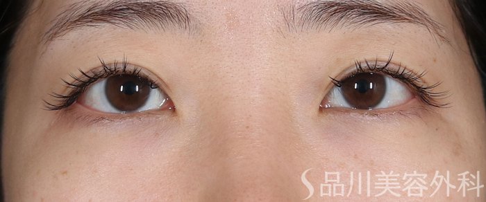 症例NO.73788のBEFORE写真