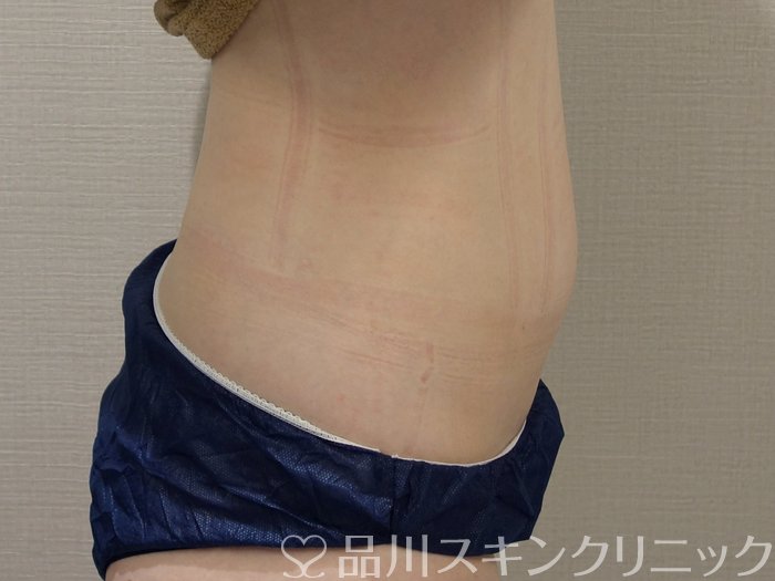 症例NO.74485のAFTER写真
