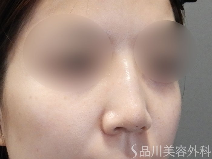 症例NO.72231のAFTER写真