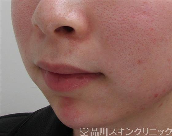 症例NO.34648のAFTER写真