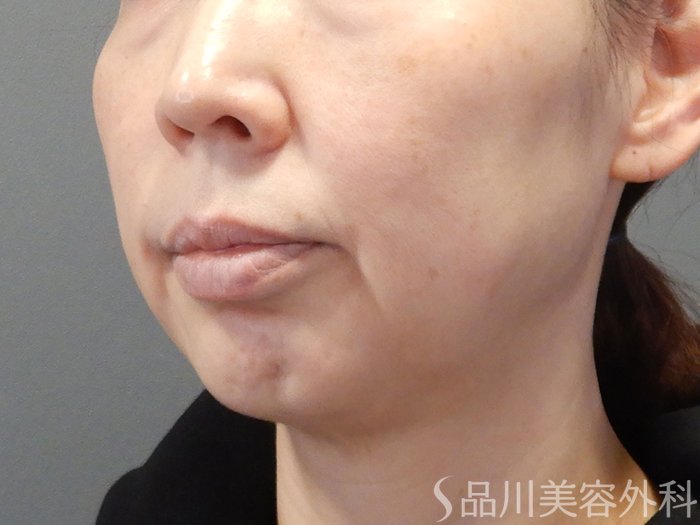 症例NO.74624のBEFORE写真