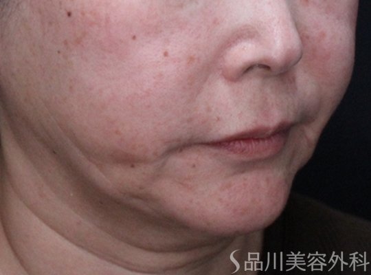 症例NO.74903のBEFORE写真