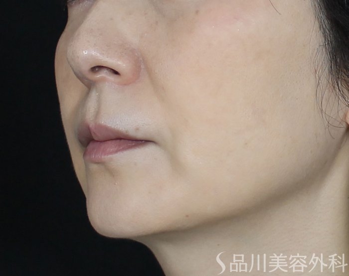 症例NO.72095のAFTER写真
