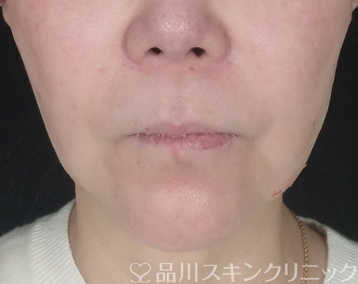 症例NO.68695のAFTER写真