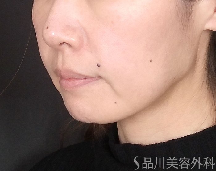 症例NO.69646のBEFORE写真