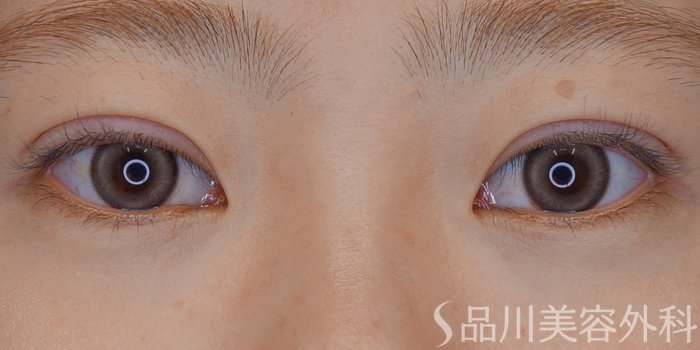 症例NO.68681のAFTER写真