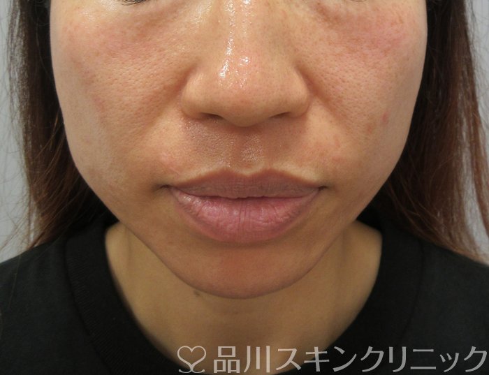 症例NO.74033のBEFORE写真