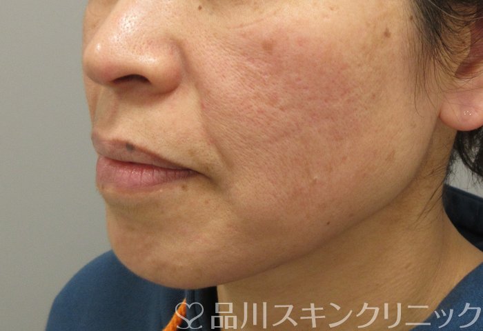 症例NO.69810のBEFORE写真