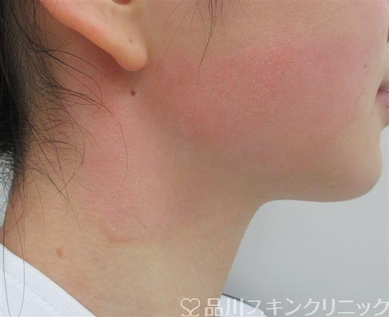 症例NO.26383のAFTER写真