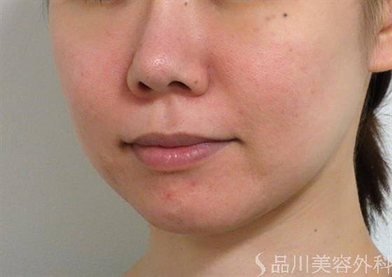 症例NO.36422のBEFORE写真