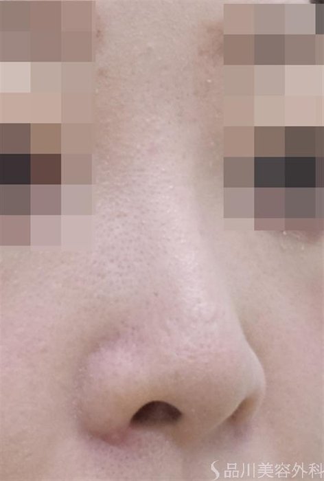 症例NO.48541のAFTER写真